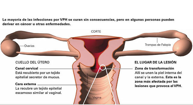 virus del papiloma en zona genital)